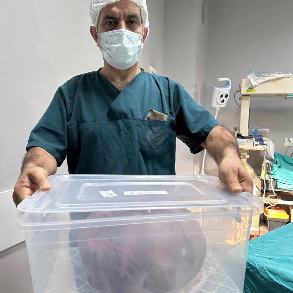 Yumurtalıktan çıkan dev kitle şoke etti!