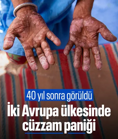 Romanya ve Hırvatistan’da 40 yılın ardından cüzzam vakaları görüldü…