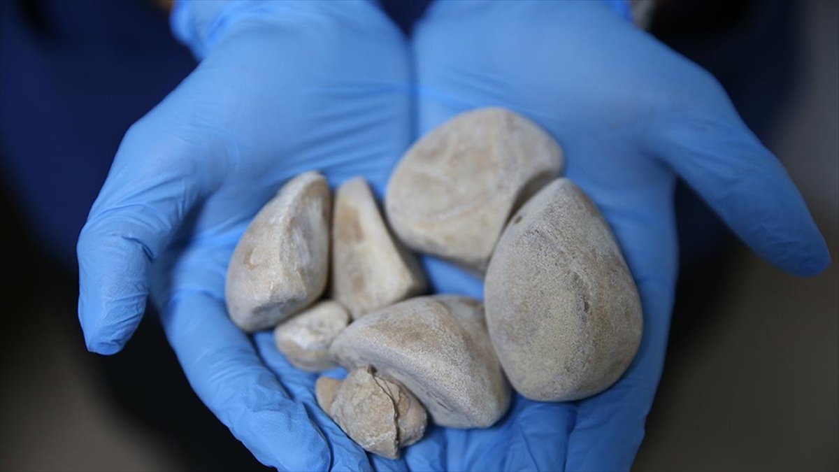 İdrar kanalı ve mesanesinden yarım kilogram ağırlığında 6 taş çıkarıldı