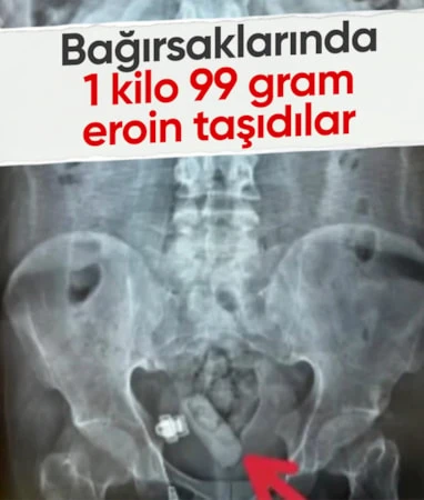 Erzincan’da yakalanan şüphelilerin mide ve bağırsağından uyuşturucu çıktı… Erzincan’da yakalanan şüphelilerin mide ve bağırsağından uyuşturucu çıktı…